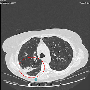 Lung pre-treatment image