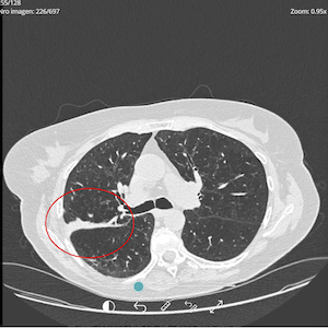 Lung pre-treatment image