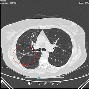 Lung post-treatment image