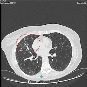 Lung pre-treatment image