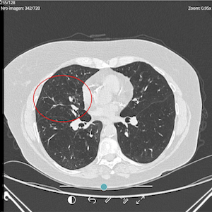 Lung post-treatment image