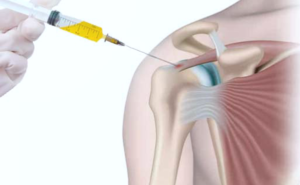 Rotator Cuff implant